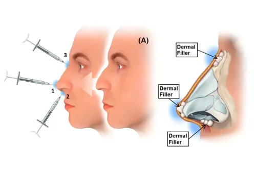فیلر بینی و نکات ایمنی آن