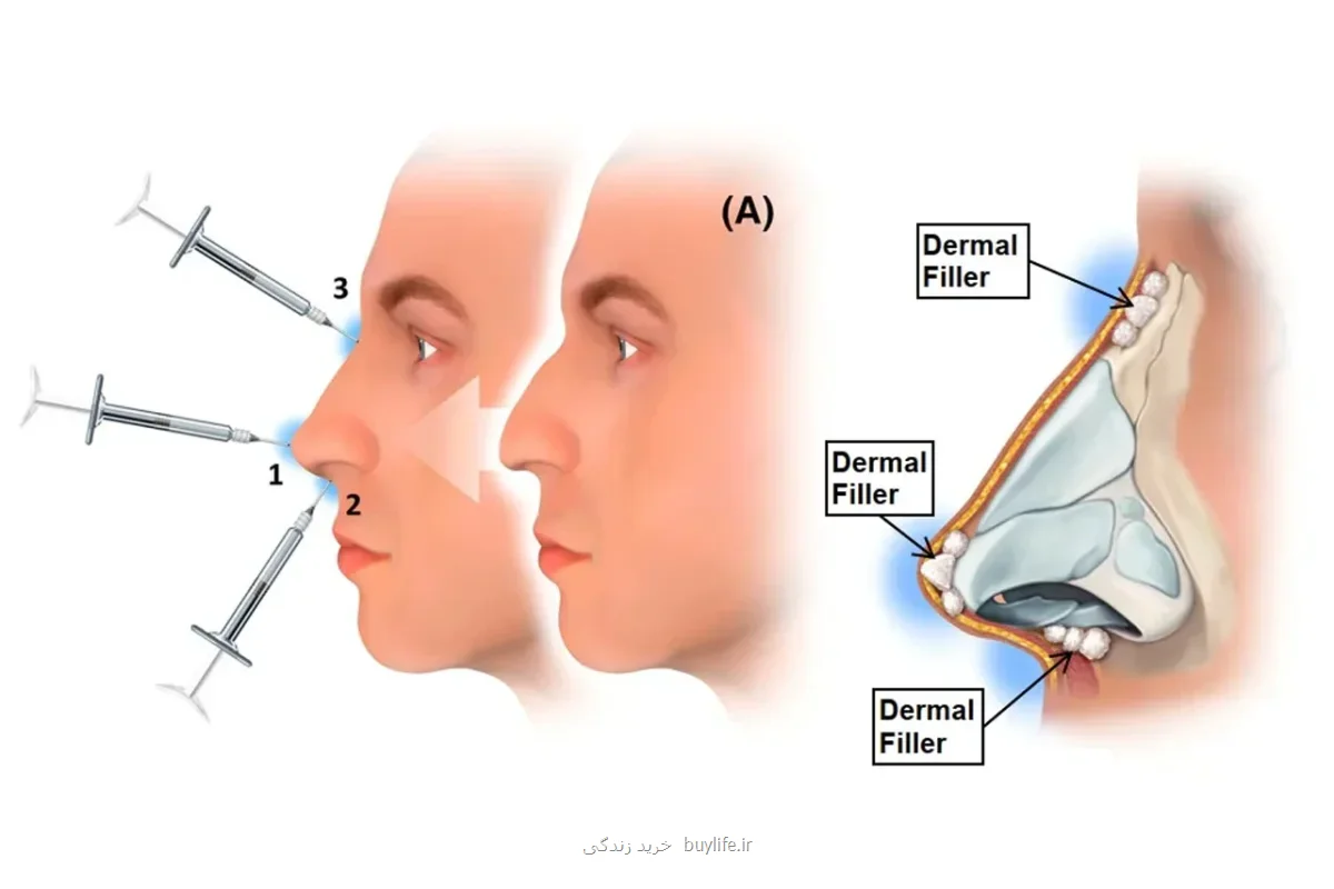 فیلر بینی و نکات ایمنی آن